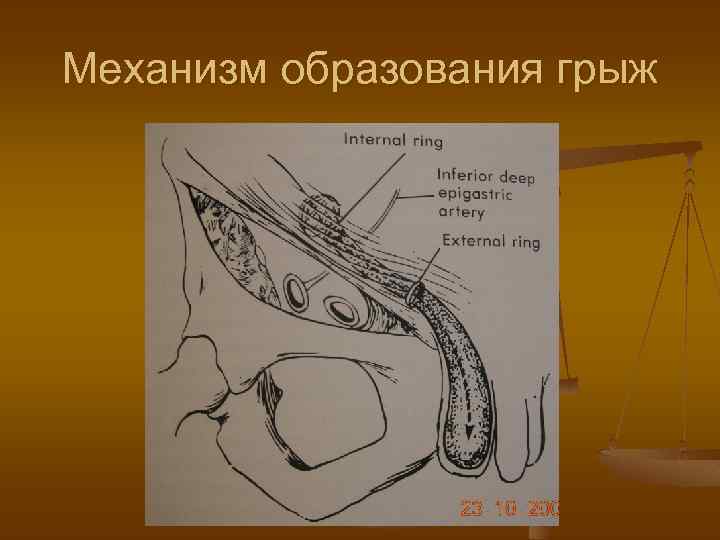 Механизм образования грыж 