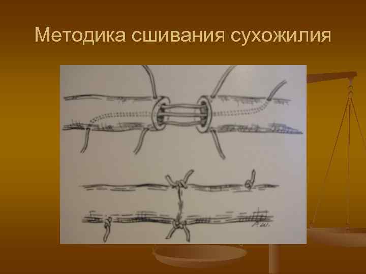 Методика сшивания сухожилия 