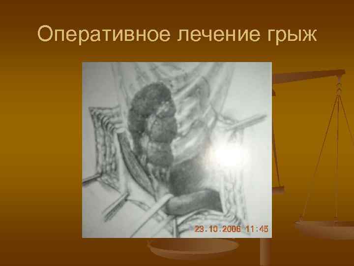 Оперативное лечение грыж 