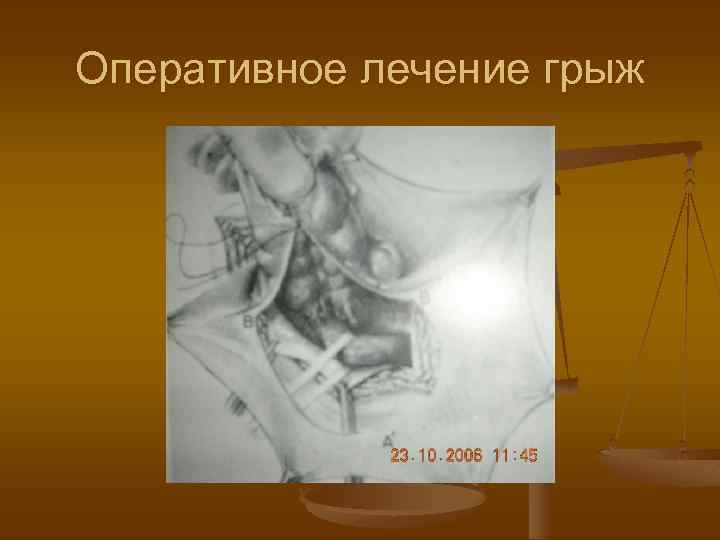 Оперативное лечение грыж 