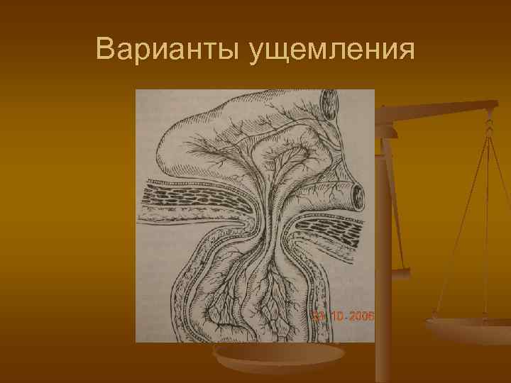 Варианты ущемления 