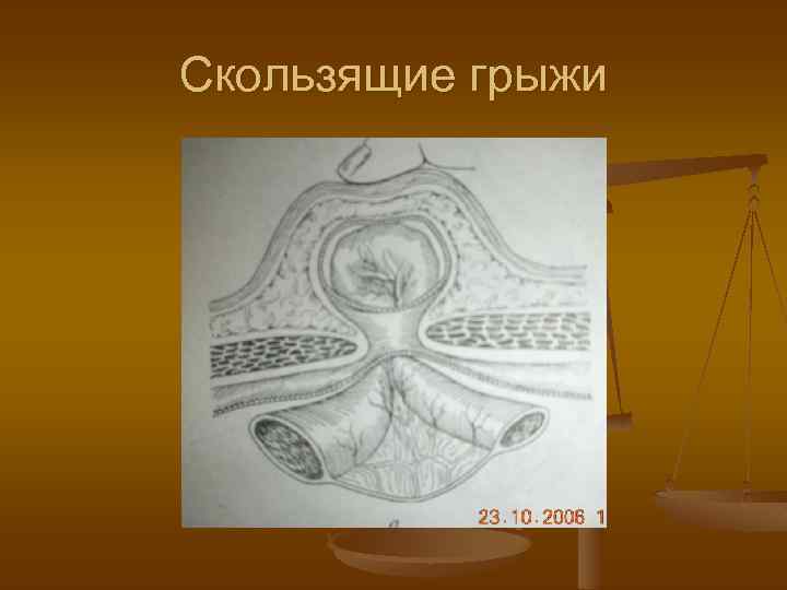 Скользящие грыжи 