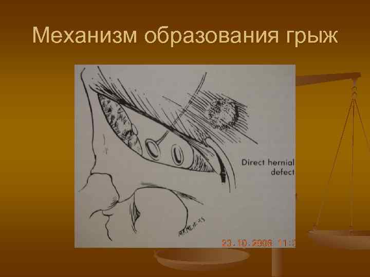 Механизм образования грыж 