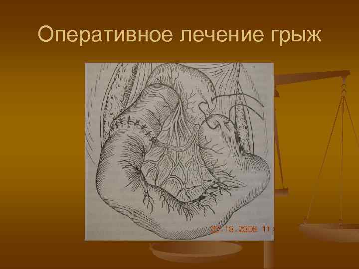 Оперативное лечение грыж 