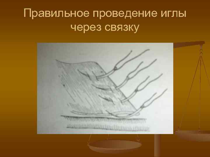 Правильное проведение иглы через связку 