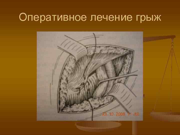 Оперативное лечение грыж 