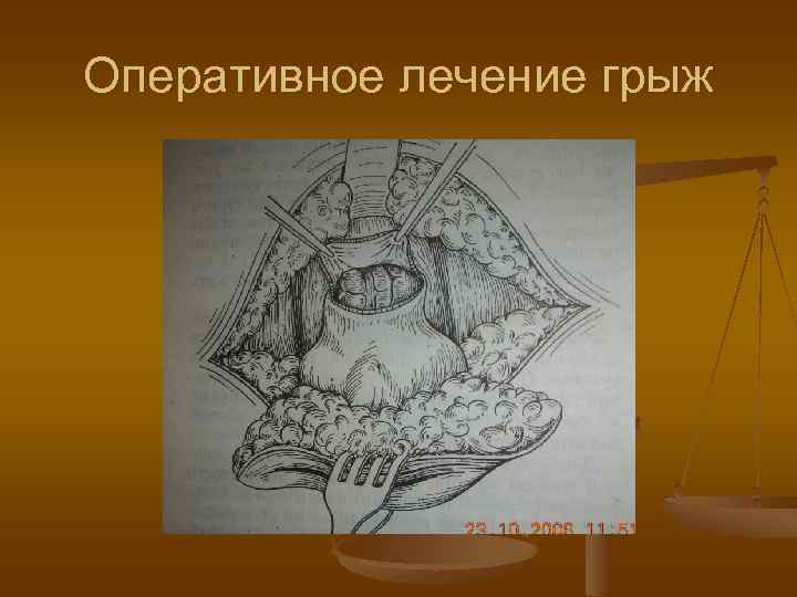 Оперативное лечение грыж 
