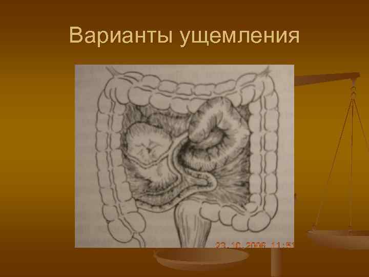 Варианты ущемления 