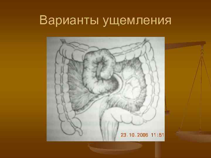 Варианты ущемления 