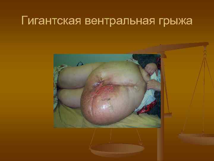 Гигантская вентральная грыжа 