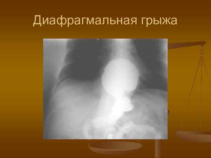 Диафрагмальная грыжа 