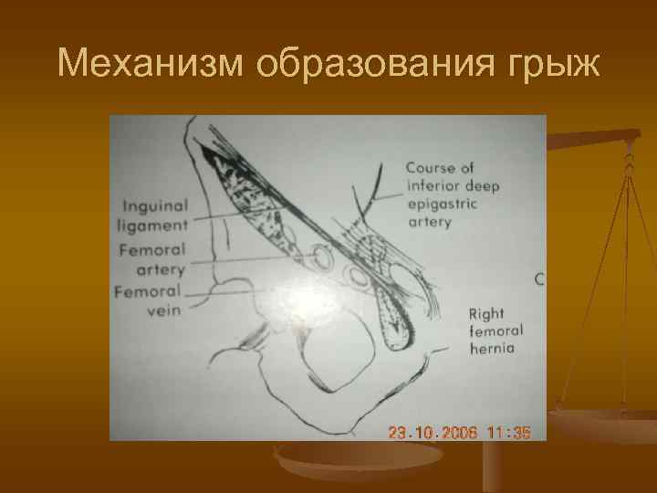 Механизм образования грыж 