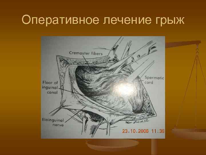 Оперативное лечение грыж 