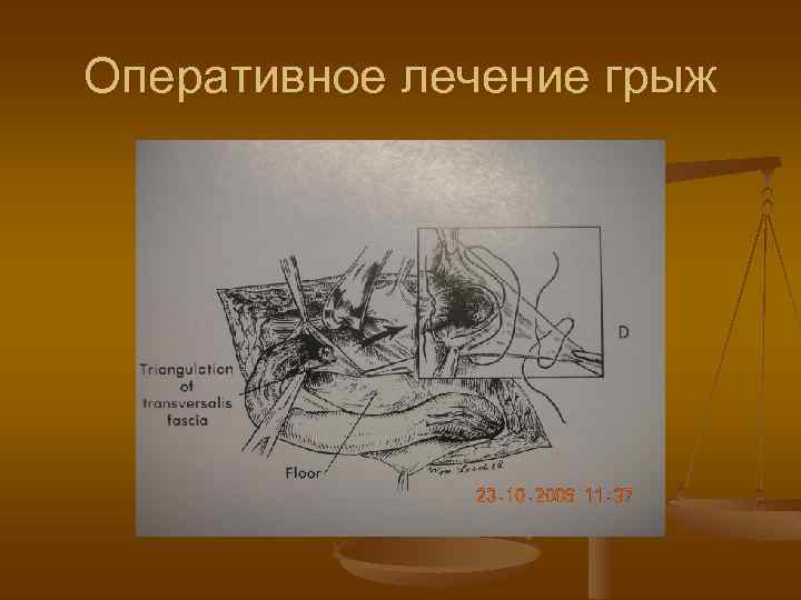 Оперативное лечение грыж 