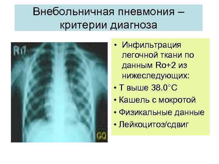 Внебольничная пневмония карта вызова