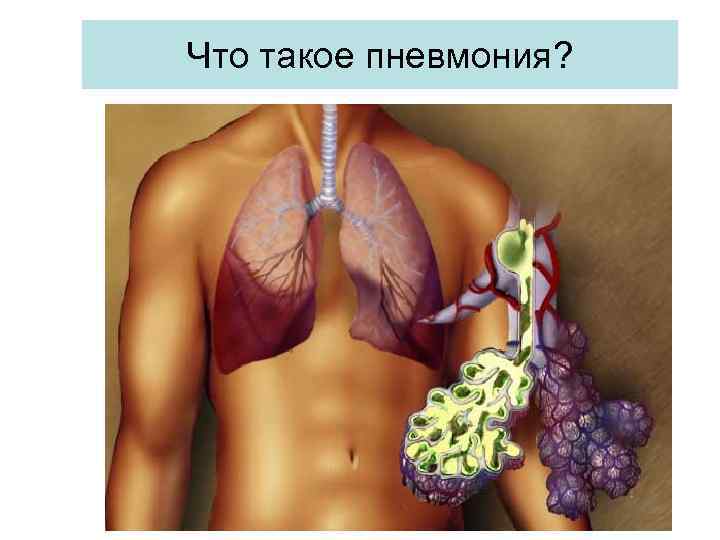 Что такое пневмония? 
