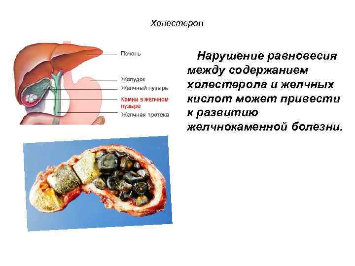 Холестерол Нарушение равновесия между содержанием холестерола и желчных кислот может привести к развитию желчнокаменной