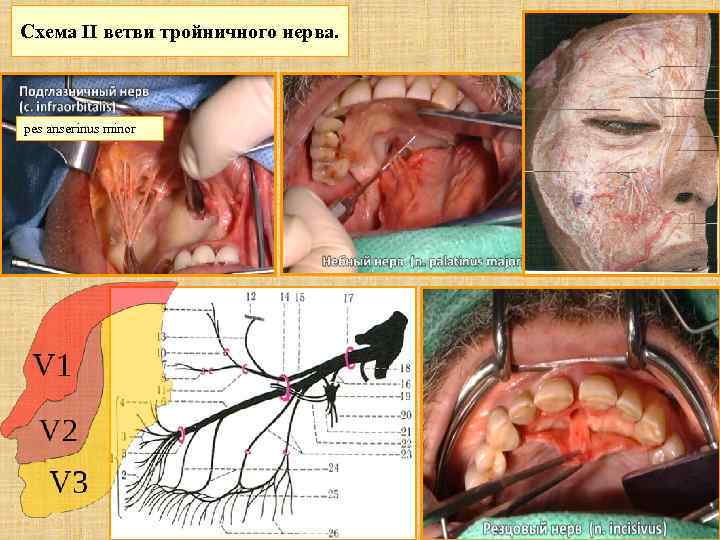 Схема II ветви тройничного нерва. pes anserinus minor 