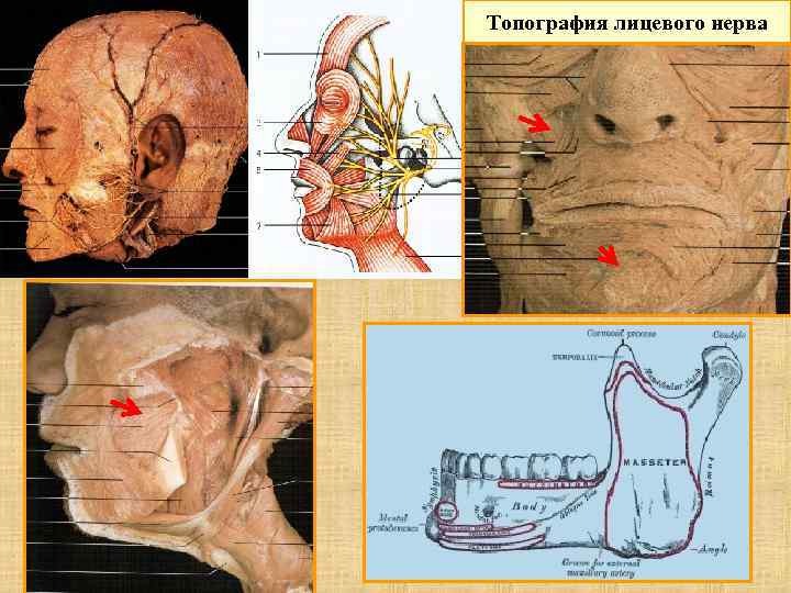 Топография лицевого нерва 