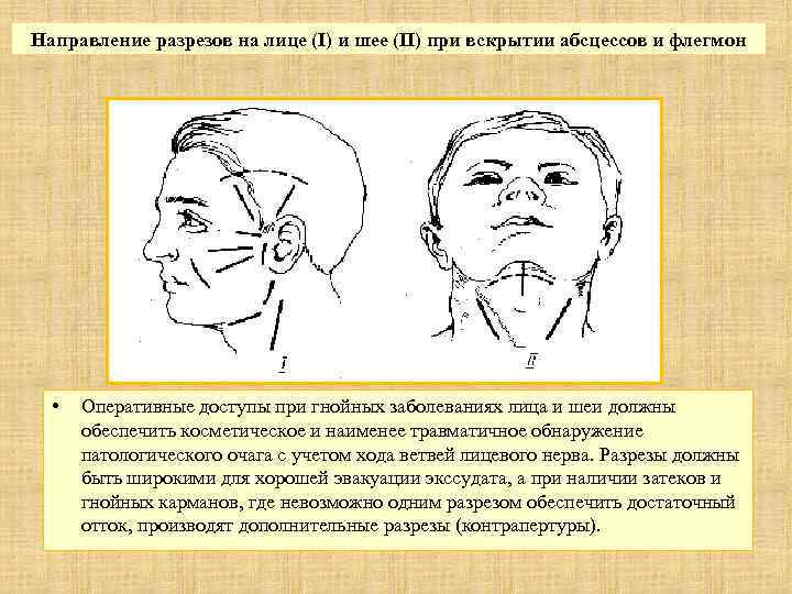 Направление разрезов на лице (I) и шее (II) при вскрытии абсцессов и флегмон •