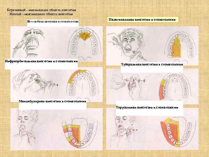 Коричневый - минимальная область анестезии Желтый - максимальная область анестезии Носо-небная анестезия в стоматологии