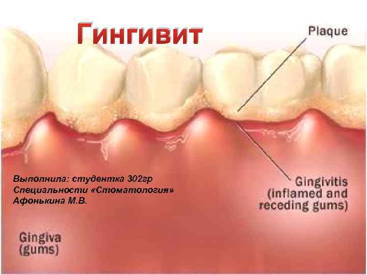 Гингивит Выполнила: студентка 302 гр Специальности «Стоматология» Афонькина М. В. 