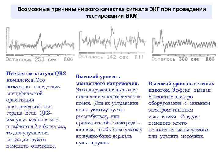 Возможные причины низкого качества сигнала ЭКГ при проведении тестирования ВКМ Низкая амплитуда QRSкомплекса. Это