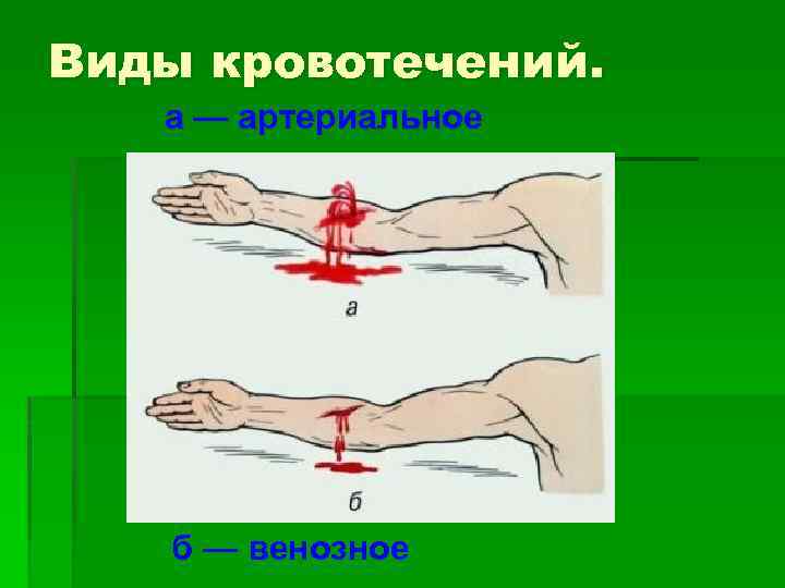 Виды кровотечений. а — артериальное б — венозное 