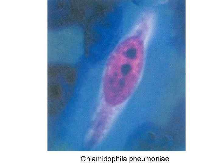Chlamidophila pneumoniae 