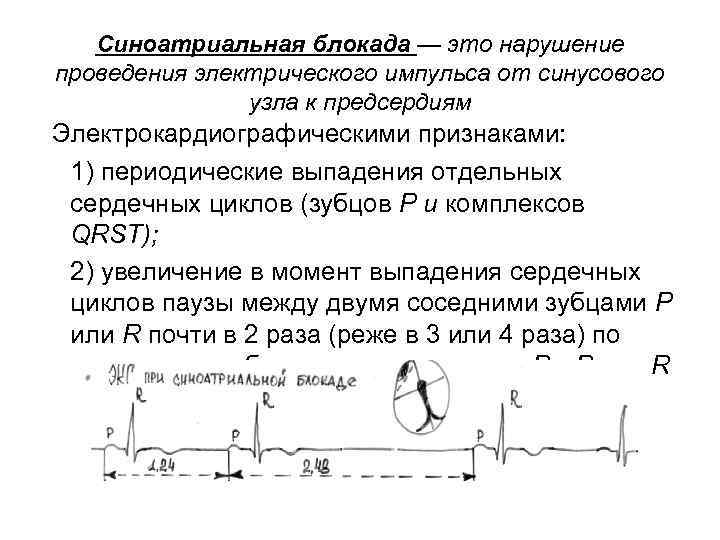Синоатриальная блокада — это нарушение проведения электрического импульса от синусового узла к предсердиям Электрокардиографическими