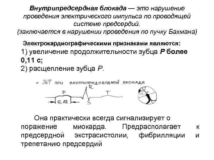 Внутрипредсердная блокада — это нарушение проведения электрического импульса по проводящей системе предсердий. (заключается в
