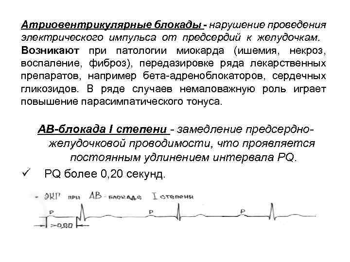 Атриовентрикулярные блокады - нарушение проведения электрического импульса от предсердий к желудочкам. Возникают при патологии