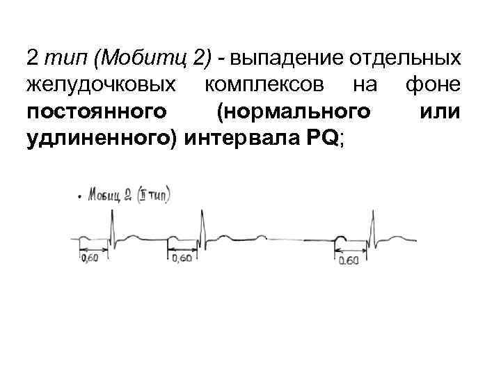 2 тип (Мобитц 2) - выпадение отдельных желудочковых комплексов на фоне постоянного (нормального или
