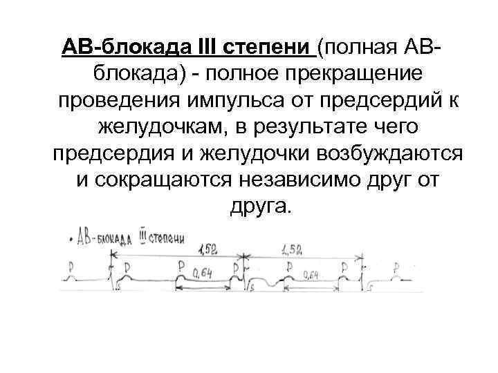  АВ-блокада III степени (полная АВ блокада) полное прекращение проведения импульса от предсердий к