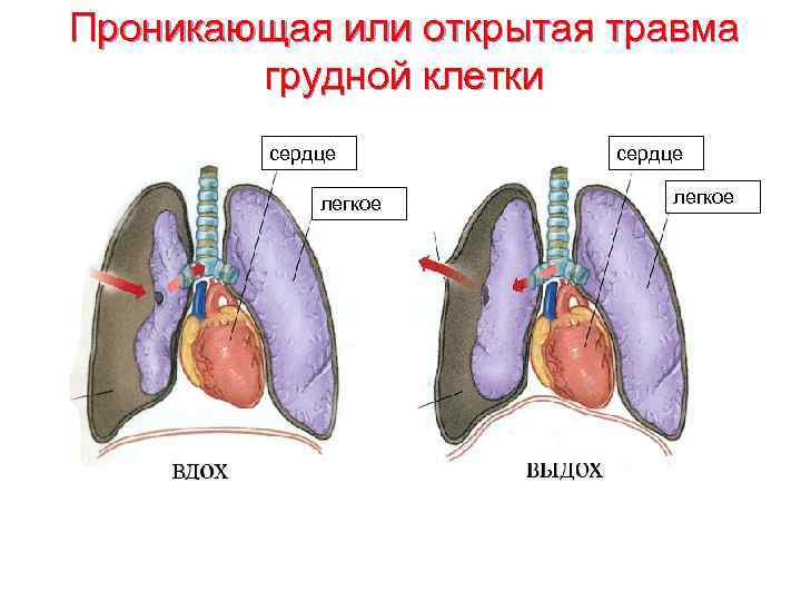 Проникающая или открытая травма грудной клетки сердце легкое 