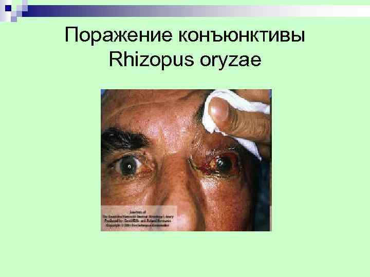 Поражение конъюнктивы Rhizopus oryzae 