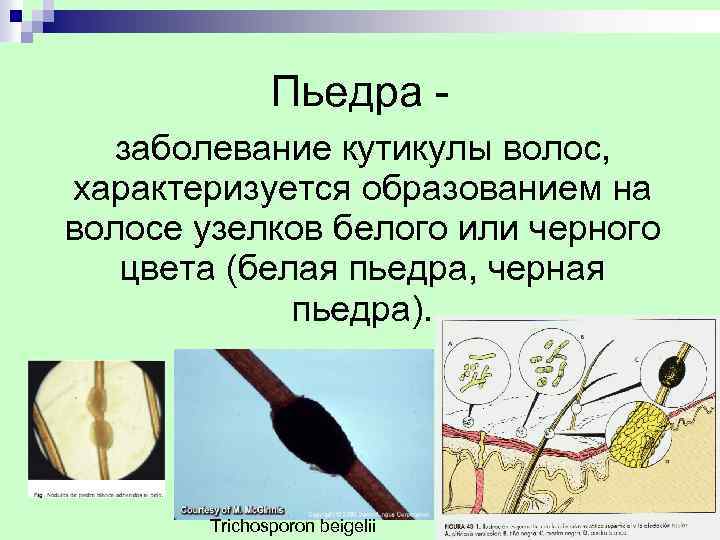  Пьедра - заболевание кутикулы волос, характеризуется образованием на волосе узелков белого или черного