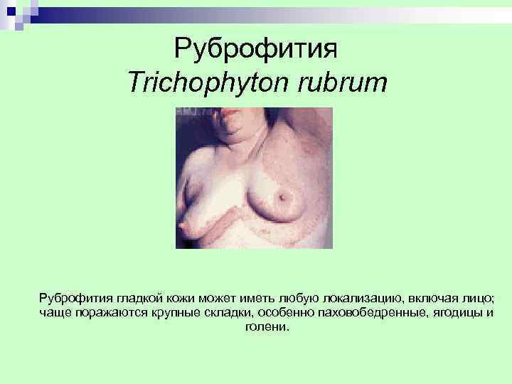  Руброфития Trichophyton rubrum Руброфития гладкой кожи может иметь любую локализацию, включая лицо; чаще