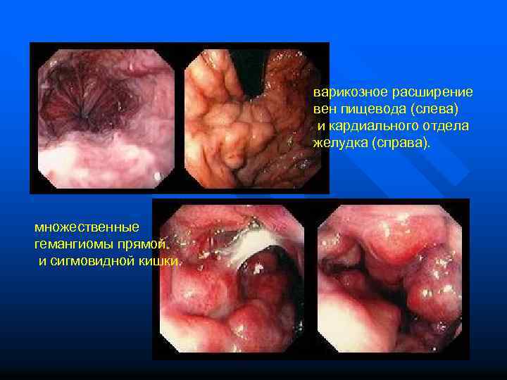  варикозное расширение вен пищевода (слева) и кардиального отдела желудка (справа). множественные гемангиомы прямой