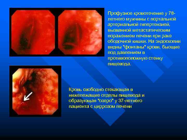  Профузное кровотечение у 78 - летнего мужчины с портальной артериальной гипертензией, вызванной метастатическим