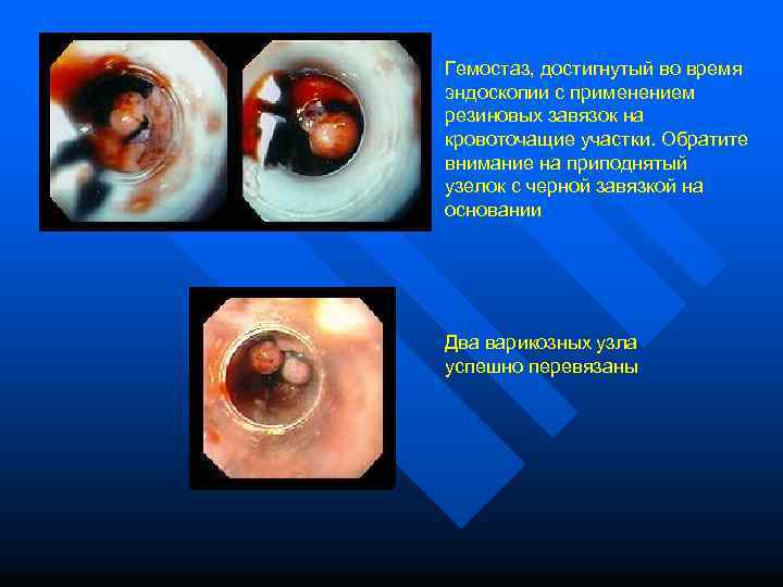 Гемостаз, достигнутый во время эндоскопии с применением резиновых завязок на кровоточащие участки. Обратите внимание