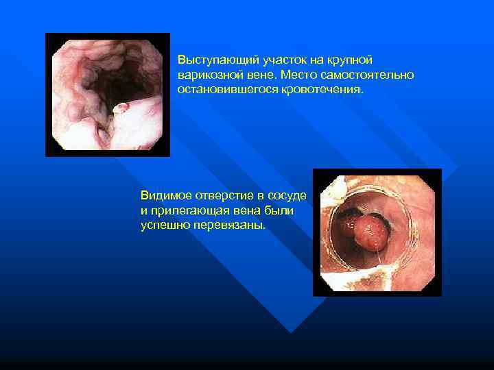  Выступающий участок на крупной варикозной вене. Место самостоятельно остановившегося кровотечения. Видимое отверстие в