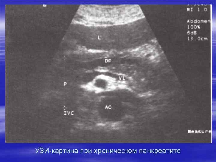 УЗИ-картина при хроническом панкреатите 