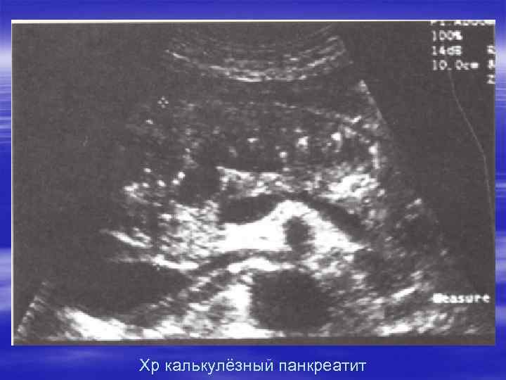 Хр калькулёзный панкреатит 