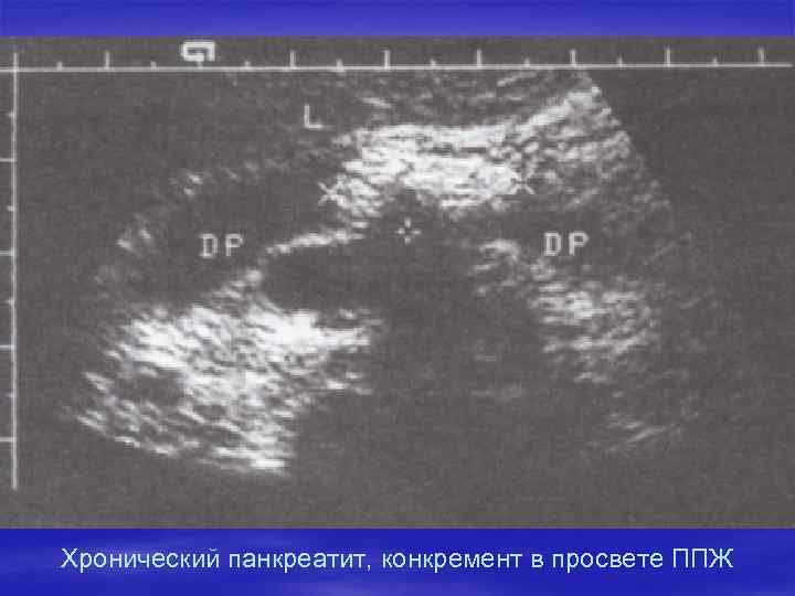 Хронический панкреатит, конкремент в просвете ППЖ 