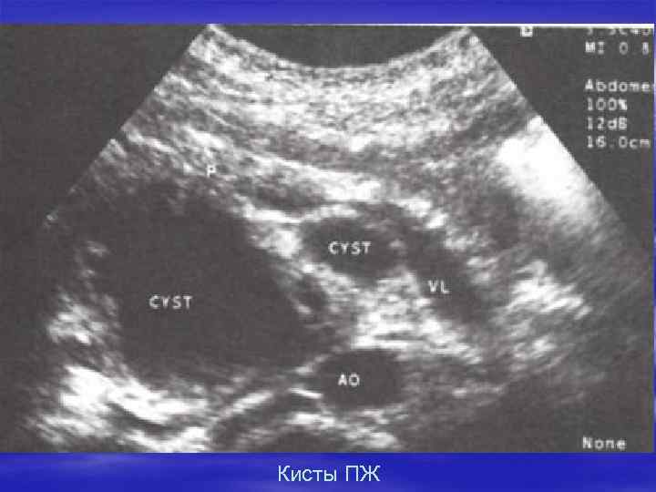 Кисты ПЖ 