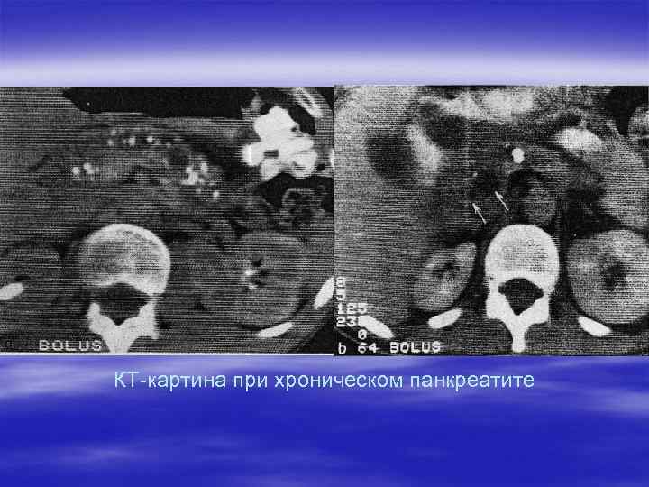 КТ-картина при хроническом панкреатите 