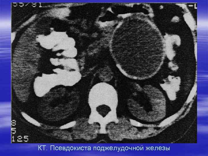 КТ. Псевдокиста поджелудочной железы 