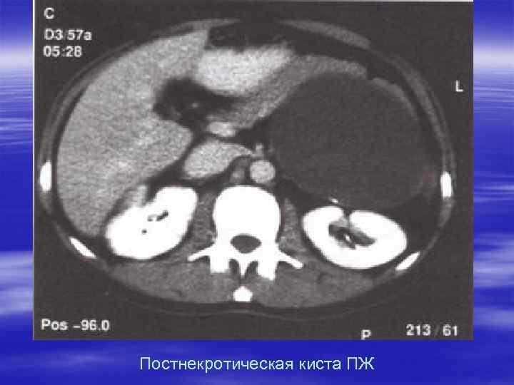 Постнекротическая киста ПЖ 