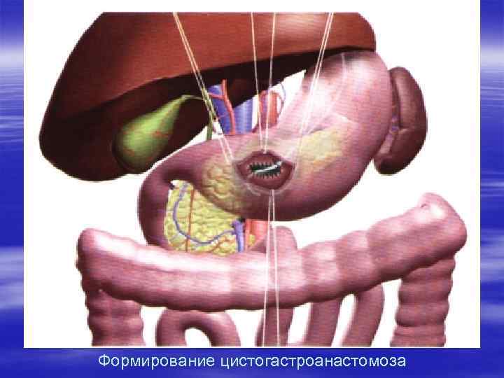 Формирование цистогастроанастомоза 